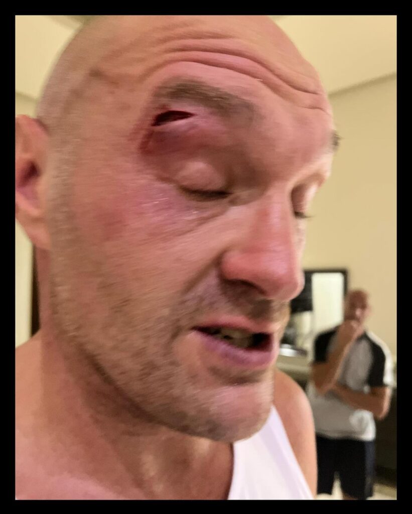 Taglio subito da Tyson Fury in allenamento in preparazione al match contro Oleksandr Usyk - Kombatnet